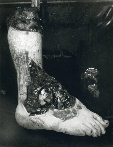 Untitled (Amputated Foot), 1939 - Frederick Sommer